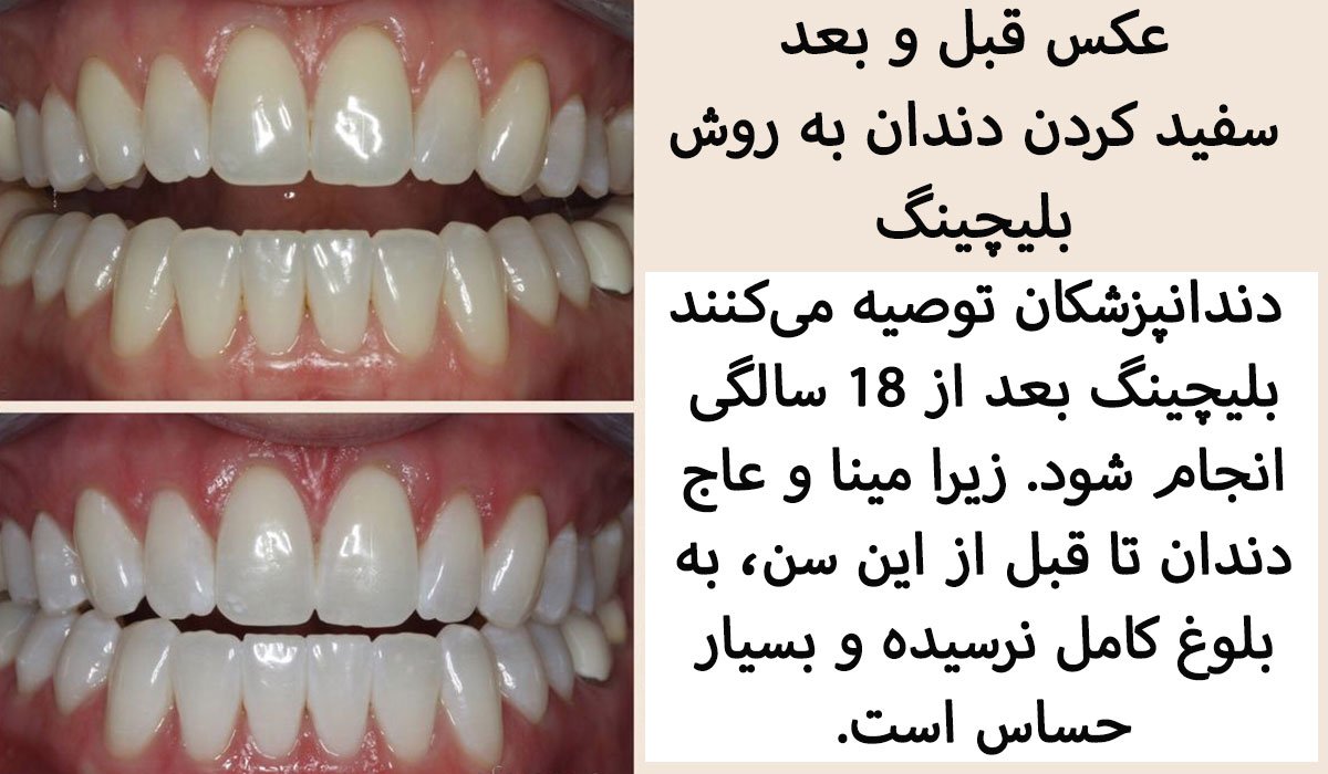 عکس بلیچینگ دندان قبل و بعد