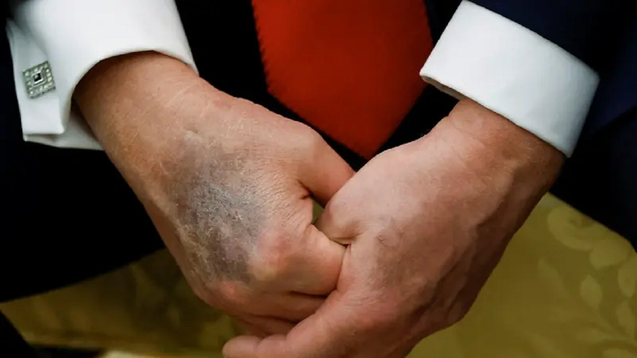 کاخ سفید چسب زخم روی دست ترامپ را به دست‌دادن‌های زیاد نسبت داد