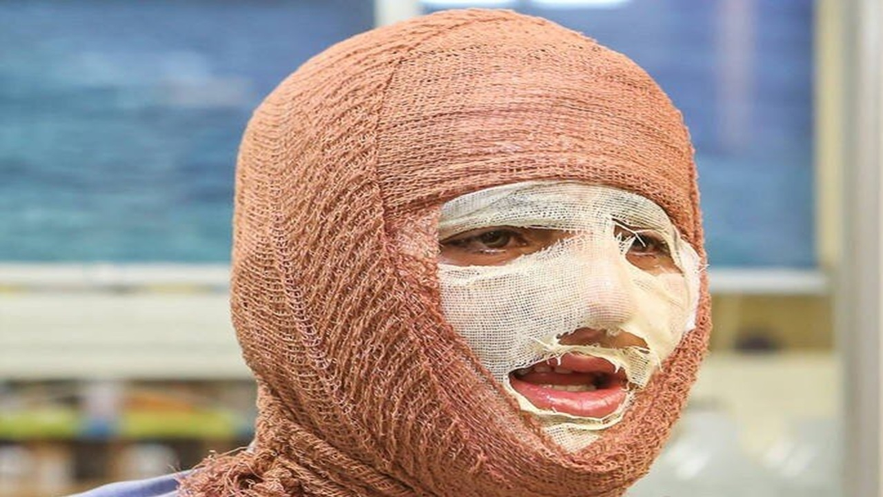 آیا بهبود کامل پس از سوختگیهای عمیق امکانپذیر است؟