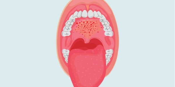 سرطان دهان چیست و چه علائمی دارد؟