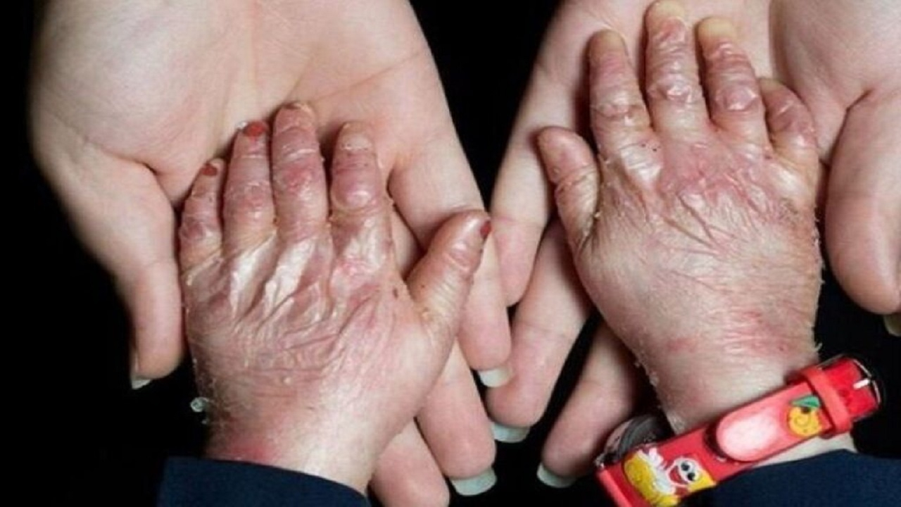 خانه‌ای‌بی؛ تداوم خدمت به بیماران پروانه‌ای در روز‌های اختلال ارتباطات