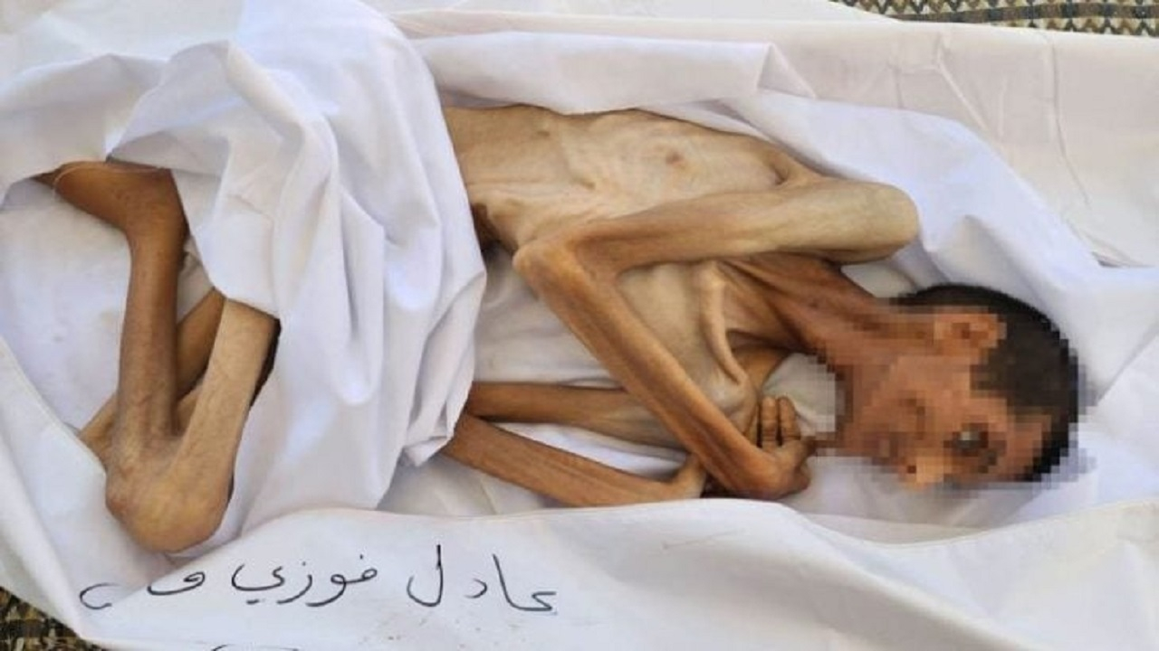 جوان ۲۷ ساله در غزه با ۱۵ کیلوگرم وزن درگذشت