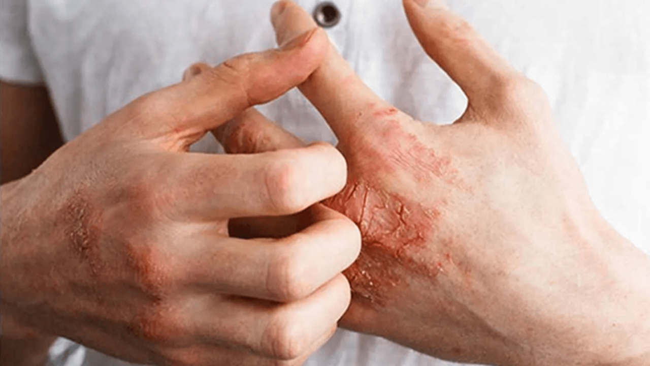 خانه تکانی شما به قیمت «اگزما» تمام نشود!