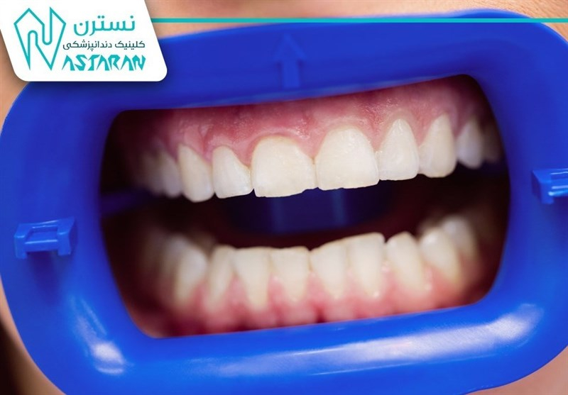 عفونتهای لثه و پیامدهای انتخاب نادرست خدمات دندانپزشکی