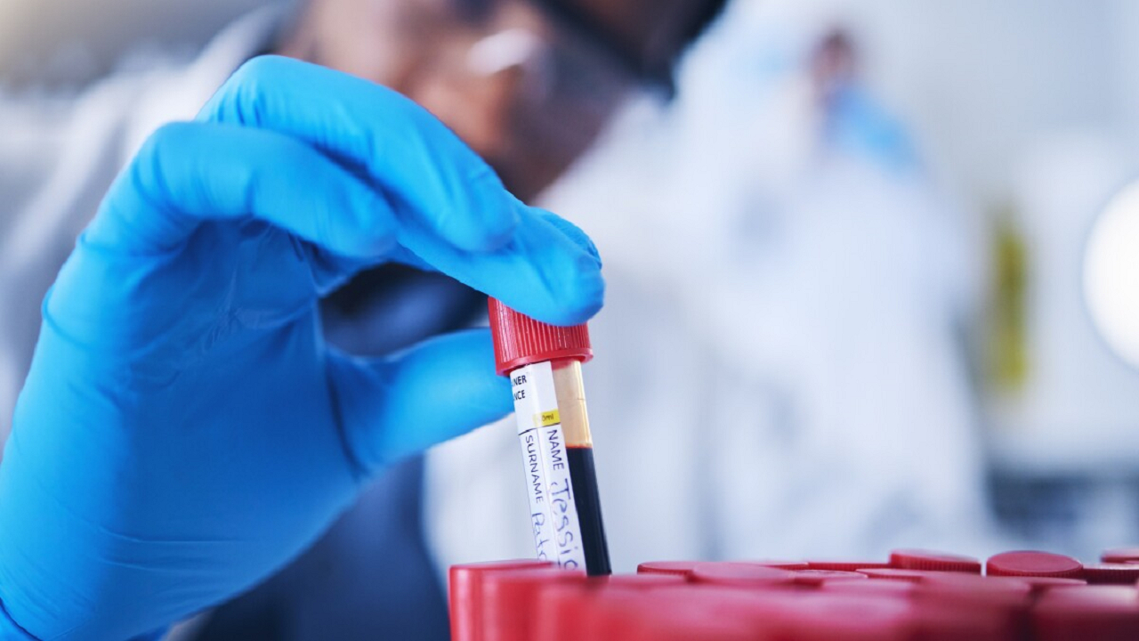 گروه خونی که بیشتر از همه سکته مغزی میکند!