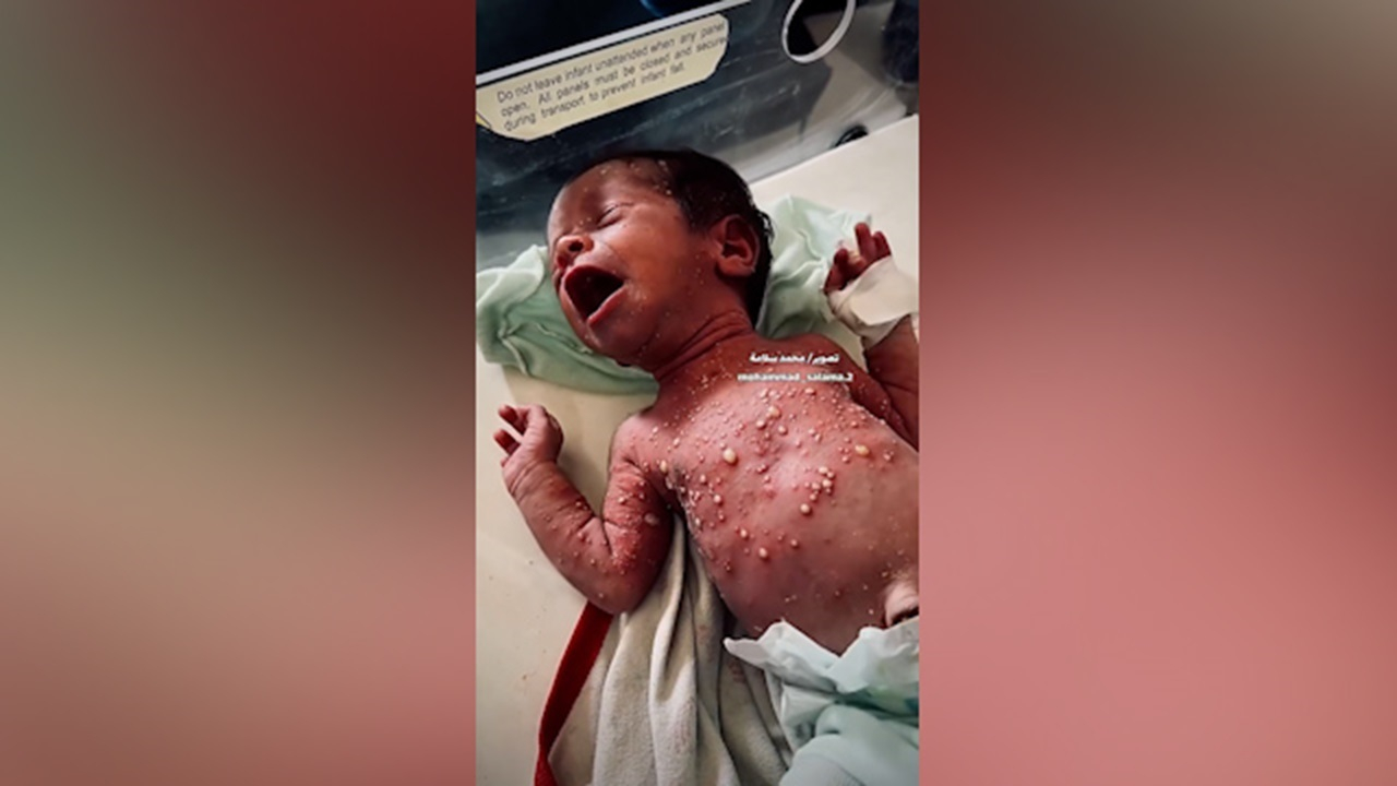 نوزاد اهل غزه بهدلیل گرما دچار تاول و بیماری پوستی دردناک شد + فیلم