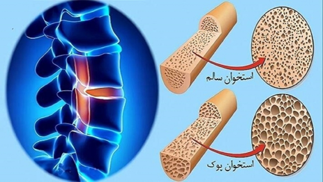 ضرورت مصرف ویتامین D توسط افراد بالای ۶۰ سال با هدف پیشگیری از پوکی استخوان