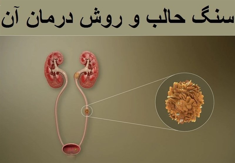 سنگ شکن حالب TUL و بهترین روش دفع سریع سنگ کلیه از حالب