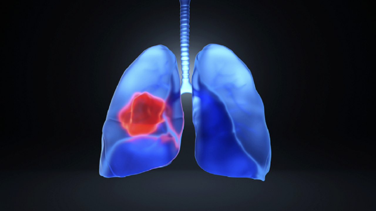 کشف عامل کلیدی توسعه سرطان ریه در مراحل اولیه