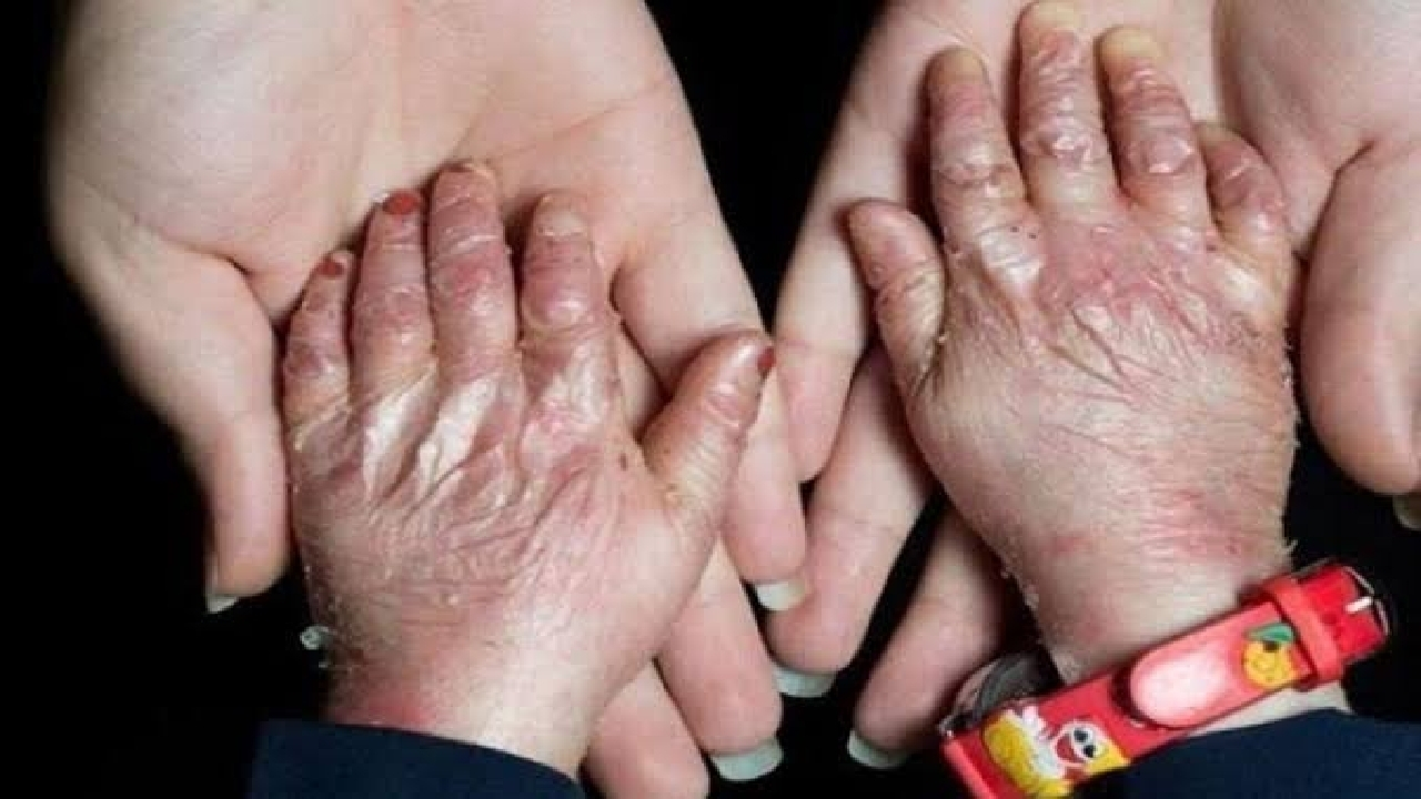 افزایش شناسایی بیماریهای نادر به دلیل پیشرفت پزشکی