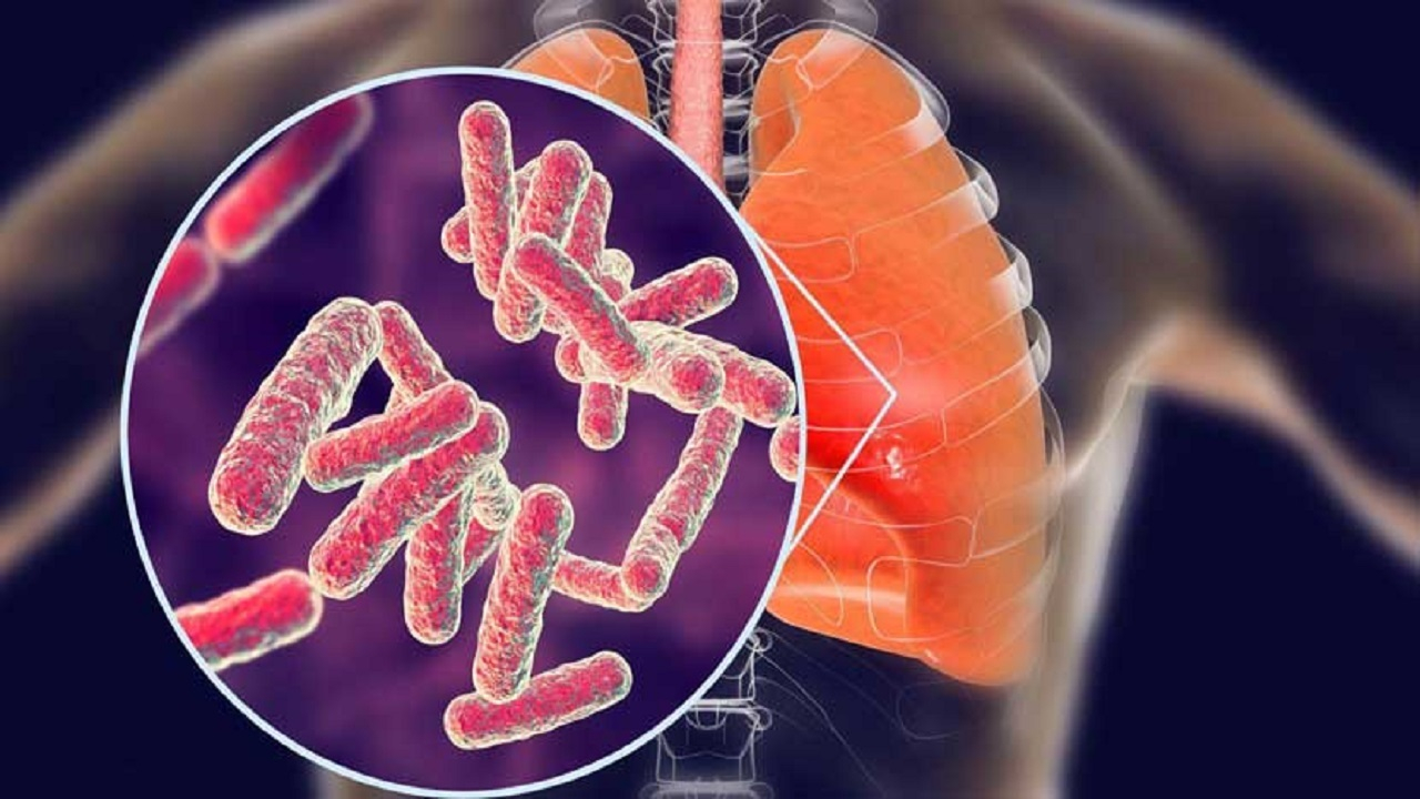 راهکارهای پیشگیری از ابتلا به بیماری سل