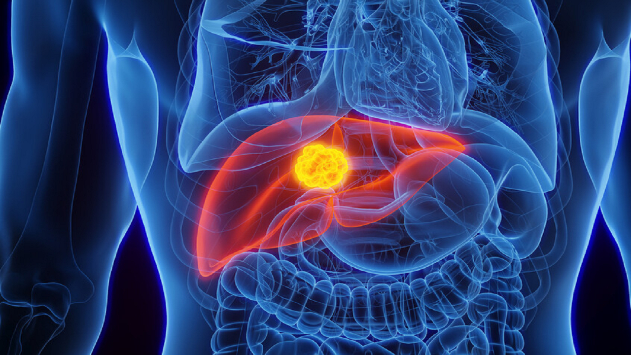 یک رویکرد جدید برای درمان مؤثرتر سرطان کبد