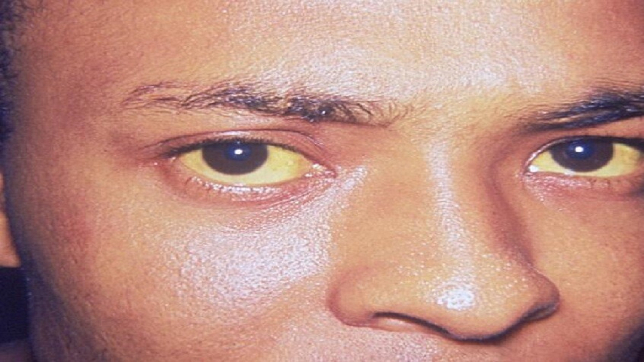 چگونه از ظاهر پوست متوجه مشکلات کیسه صفرا شویم؟